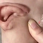 Китаянка пять месяцев носила пересаженное ухо на стопе в ожидании финальной операции