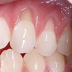 Стоматолог рассказал, как длительный стресс разрушает здоровье десен