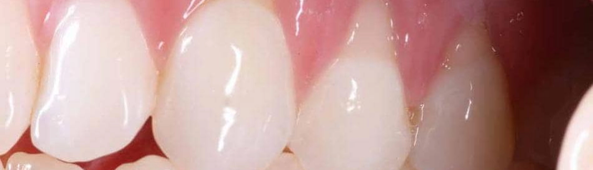 Стоматолог рассказал, как длительный стресс разрушает здоровье десен