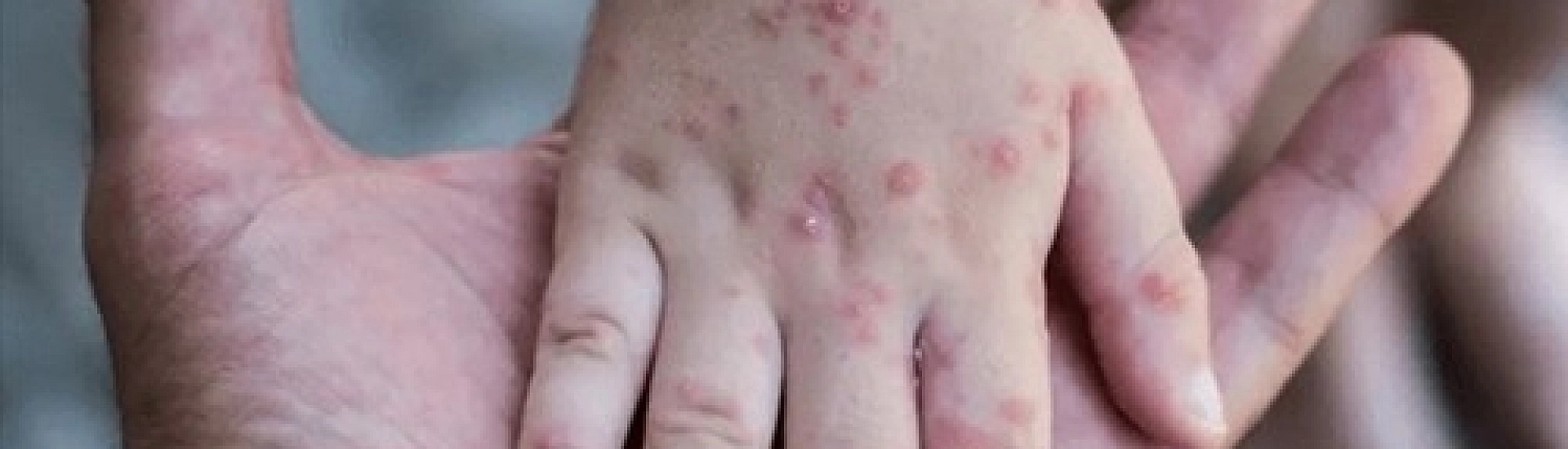 В Подмосковье выявили контактных лиц пациента с оспой обезьян