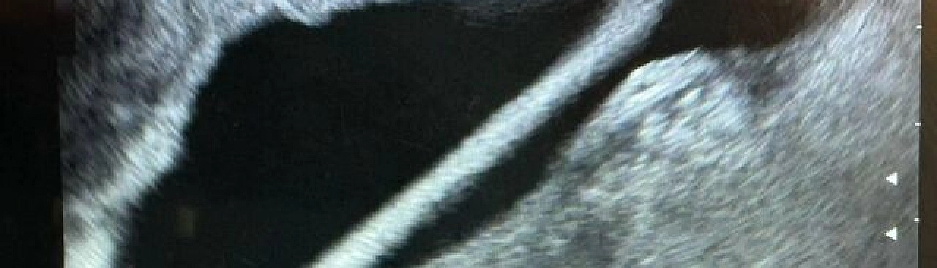 В московской больнице у подростка из мочевого пузыря извлекли комок пластилина