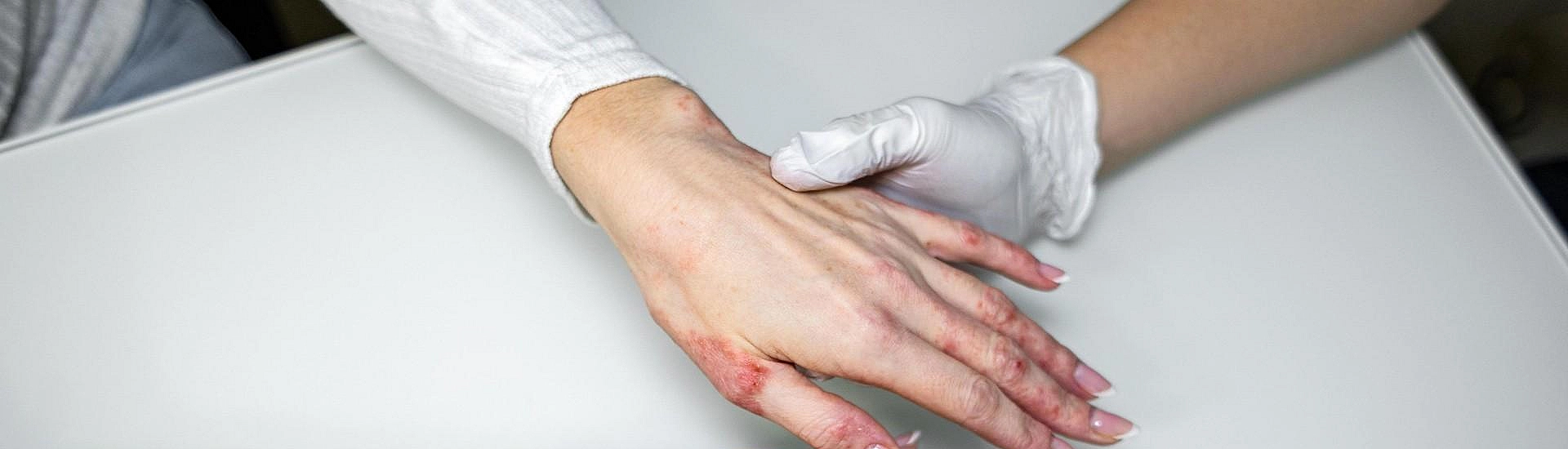 Ученые связали стресс с обострением экземы