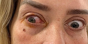 Жительница Англии временно ослепла из-за ношения контактных линз без перерыва