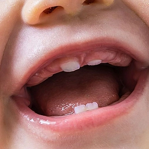 Высокий стресс у беременных ускоряет прорезывание молочных зубов у детей