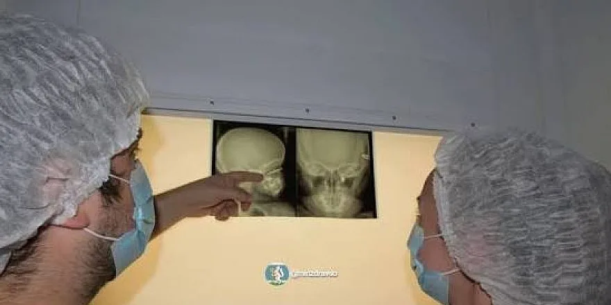В Свердловской области врачи спасли глаз двухлетнему мальчику после травмы саморезом